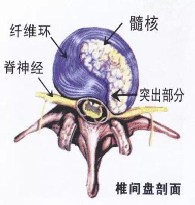 瑜伽如何幫你預(yù)防腰間盤突出？